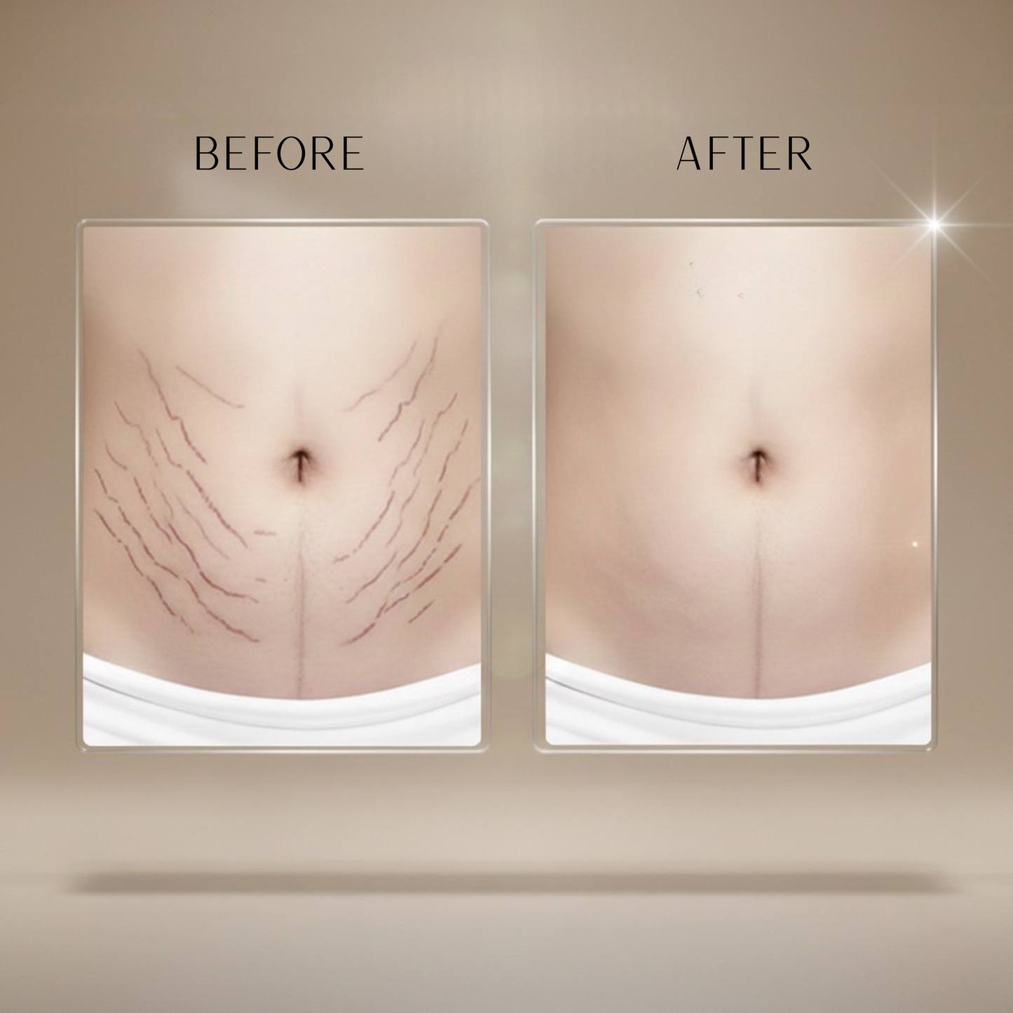 Blue Light Stretch Mark Removal Tool and Scar Cream